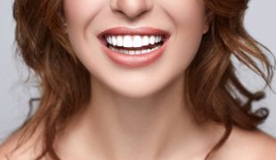 Hollywood Smile package example showing a bright, uniform veneer result