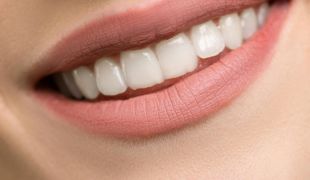 Perfect Smile package example showing metal-porcelain crowns transformation