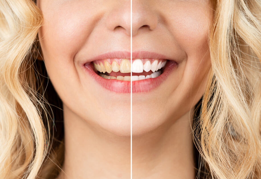 Before and after: brighter, even smile makeover in just one afternoon