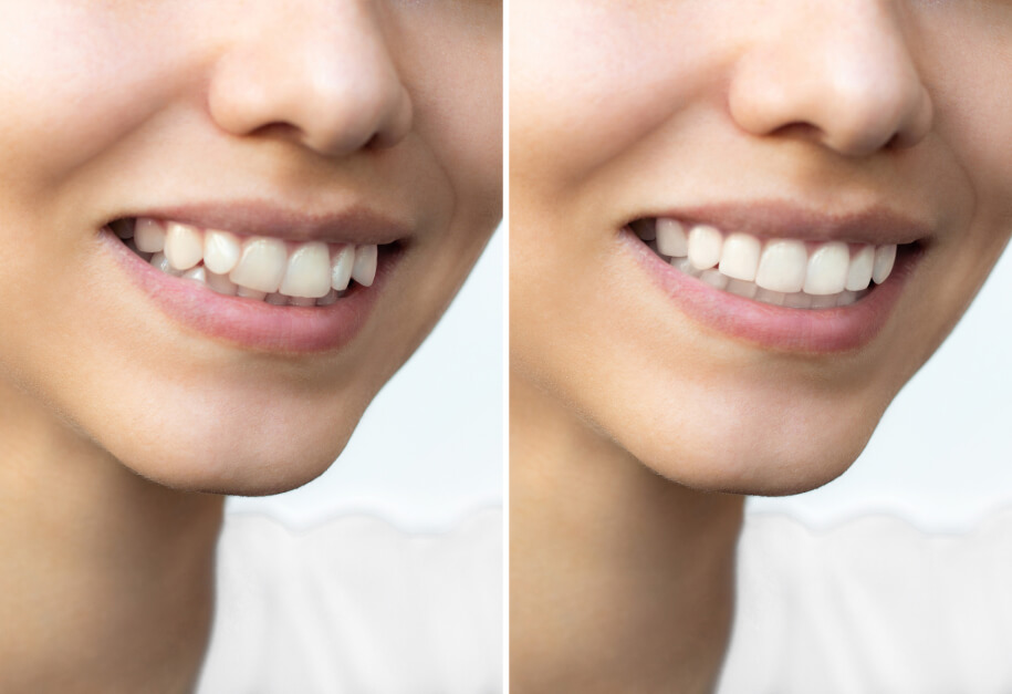 Before and after: gap-free confidence smile transformation in a single morning