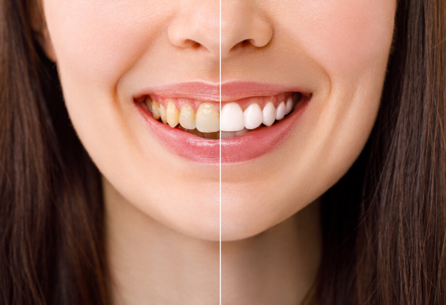 Before and after: instant teeth brightening whitening under an hour