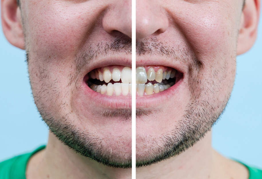Before and after: strong new tooth implant smile restoration in one quick appointment